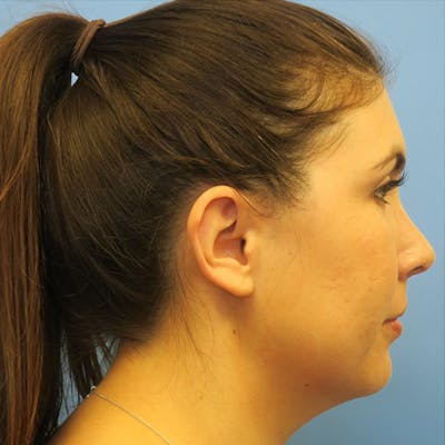 Neck Liposuction Before & After Gallery - Patient 4752051 - Image 1
