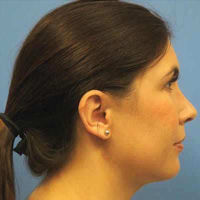 Neck Liposuction Before & After Gallery - Patient 4752051 - Image 2