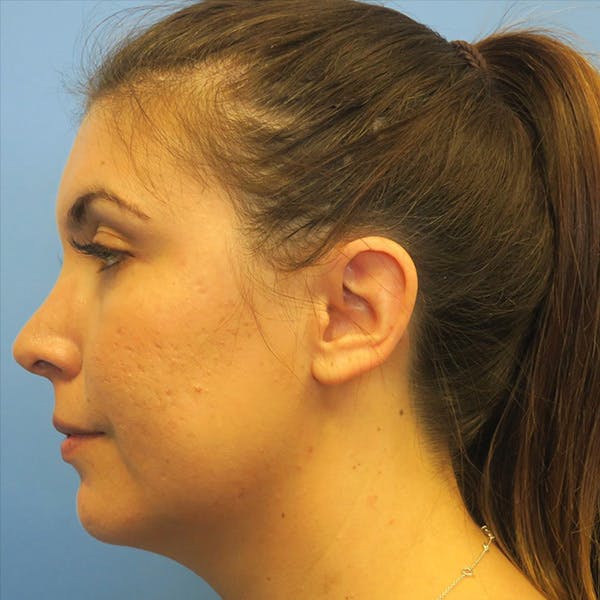 Neck Liposuction Before & After Gallery - Patient 4752051 - Image 3