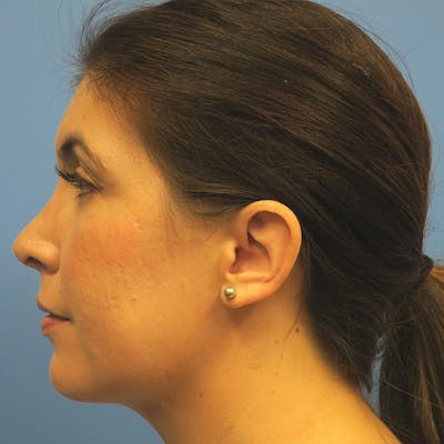 Neck Liposuction Before & After Gallery - Patient 4752051 - Image 4