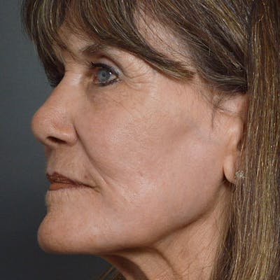 CO2 Laser Resurfacing Before & After Gallery - Patient 7369306 - Image 2