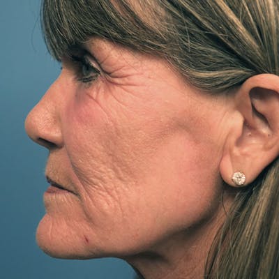 CO2 Laser Resurfacing Before & After Gallery - Patient 7369306 - Image 1
