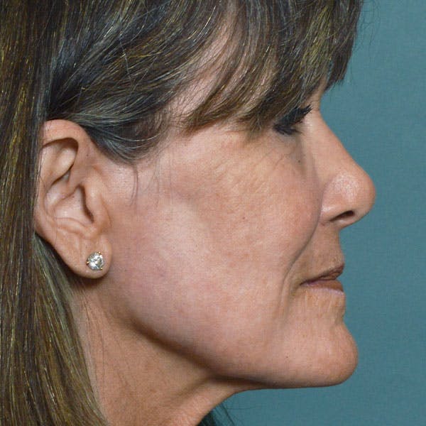 CO2 Laser Resurfacing Before & After Gallery - Patient 7369306 - Image 4