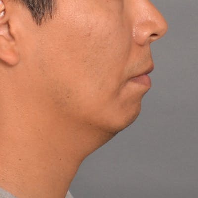 Chin Surgery Before & After Gallery - Patient 16688866 - Image 1
