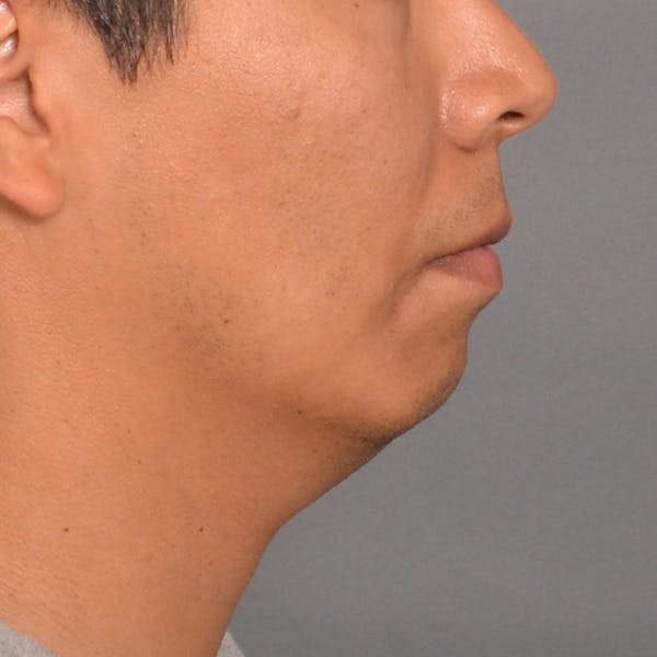 Chin Surgery Before & After Gallery - Patient 16688866 - Image 1