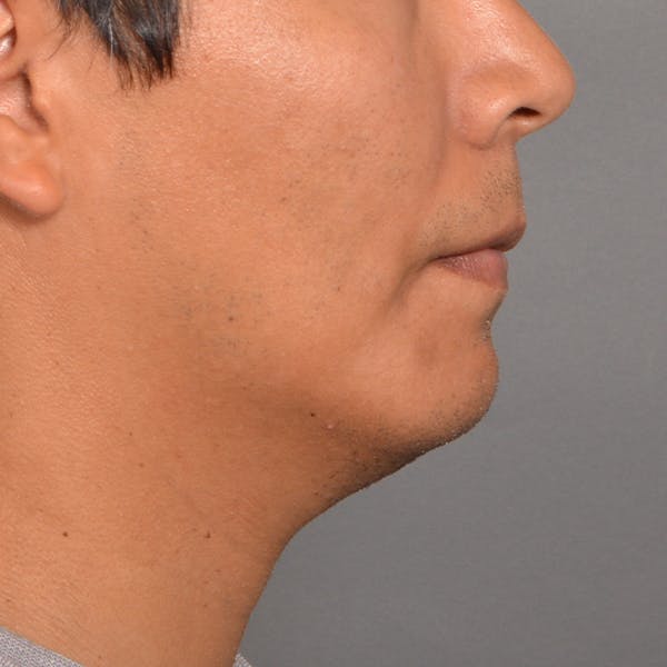 Chin Surgery Gallery - Patient 16688866 - Image 2