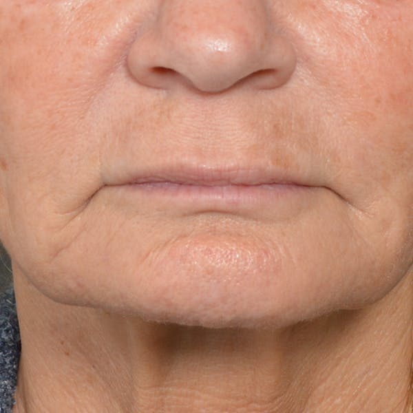 Lip Lift Before & After Gallery - Patient 24300366 - Image 1