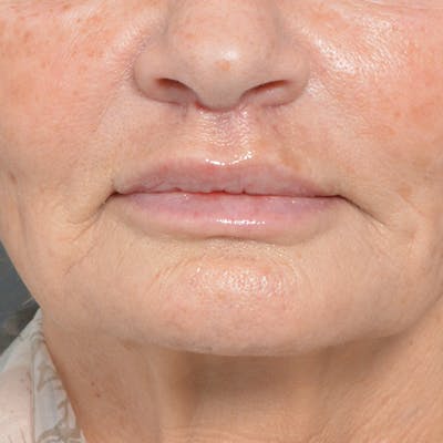 Lip Lift Before & After Gallery - Patient 24300366 - Image 2