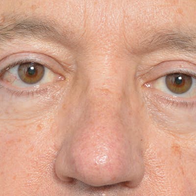Eyelid Surgery Before & After Gallery - Patient 24300409 - Image 2