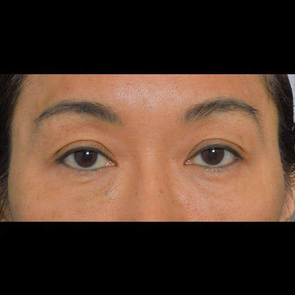 Eyelid Surgery Before & After Gallery - Patient 26873284 - Image 1
