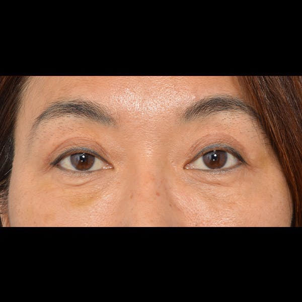 Eyelid Surgery Gallery - Patient 26873284 - Image 2
