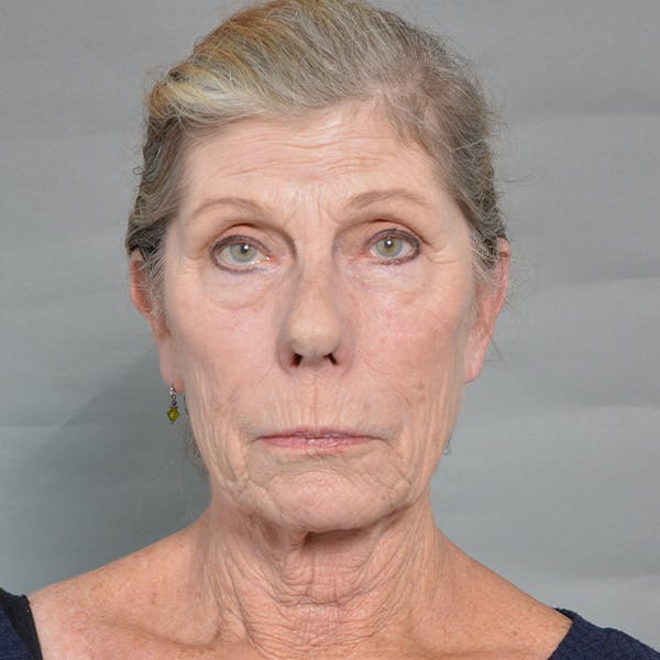 CO2 Laser Resurfacing Before & After Gallery - Patient 39346967 - Image 1