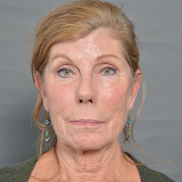 CO2 Laser Resurfacing Before & After Gallery - Patient 39346967 - Image 2