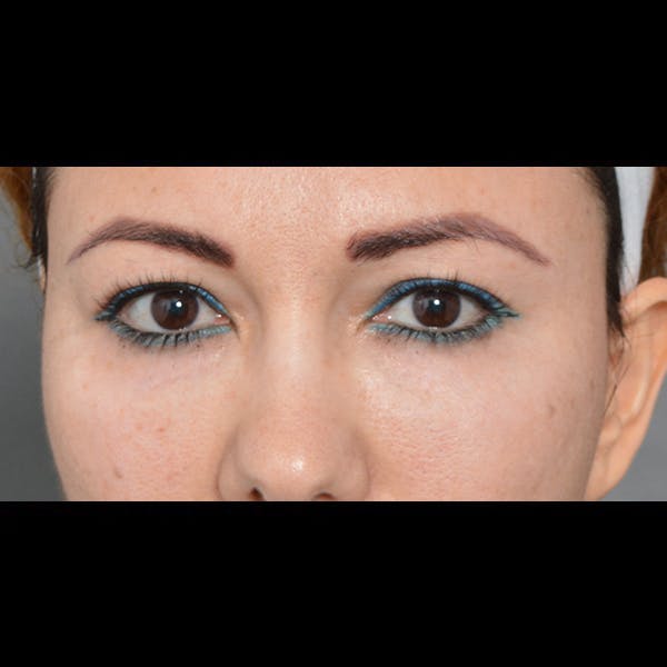 Eyelid Surgery Before & After Gallery - Patient 54203774 - Image 1