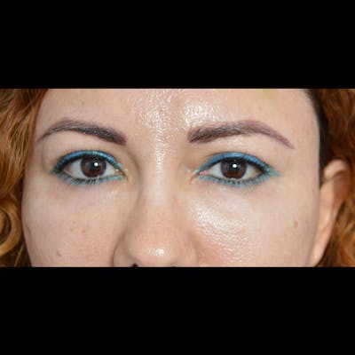 Eyelid Surgery Before & After Gallery - Patient 54203774 - Image 2