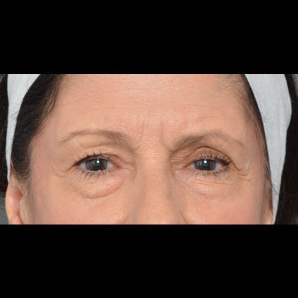 Eyelid Surgery Before & After Gallery - Patient 64221567 - Image 1