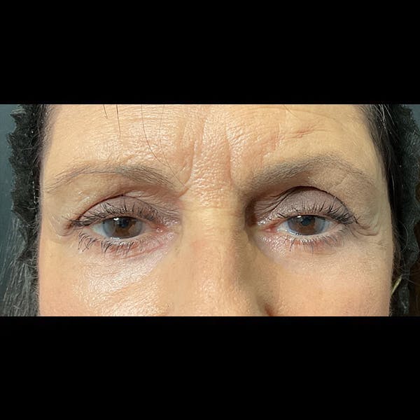 Eyelid Surgery Before & After Gallery - Patient 64221567 - Image 2