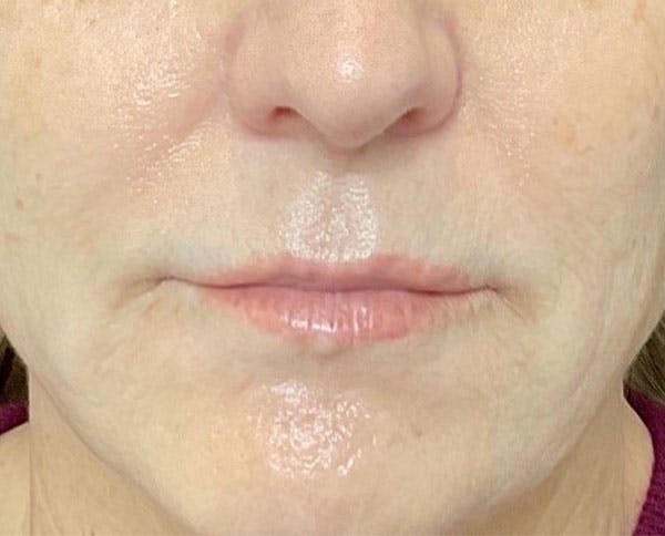 Lip Lift Before & After Gallery - Patient 96929250 - Image 1