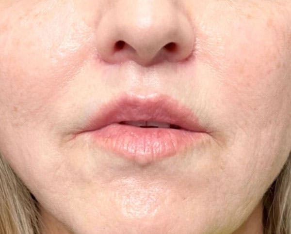 Lip Lift Before & After Gallery - Patient 96929250 - Image 2