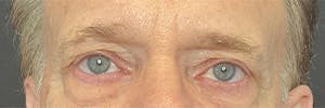 Brow Lift Before & After Gallery - Patient 145833750 - Image 1