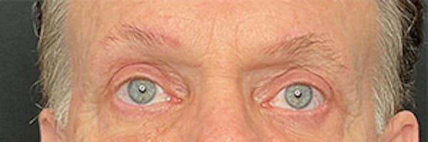 Brow Lift Before & After Gallery - Patient 145833750 - Image 2