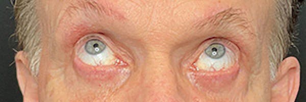 Brow Lift Before & After Gallery - Patient 145833750 - Image 4