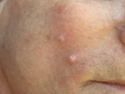 Mole Removal Before & After Gallery - Patient 146131351 - Image 1