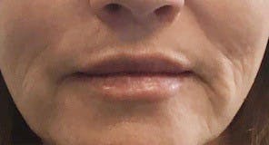 Lip Lift Before & After Gallery - Patient 146779454 - Image 1