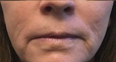 Lip Lift Before & After Gallery - Patient 146779454 - Image 2