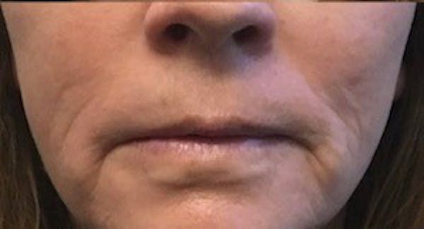 Lip Lift Before & After Gallery - Patient 146779454 - Image 2