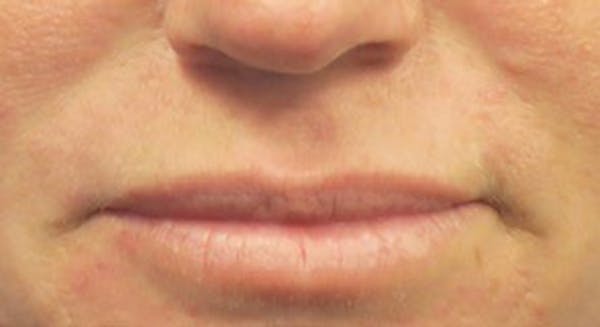 Lip Lift Before & After Gallery - Patient 146779458 - Image 1