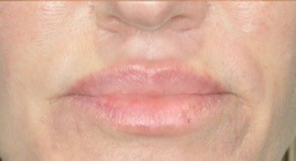 Lip Lift Before & After Gallery - Patient 146779458 - Image 2