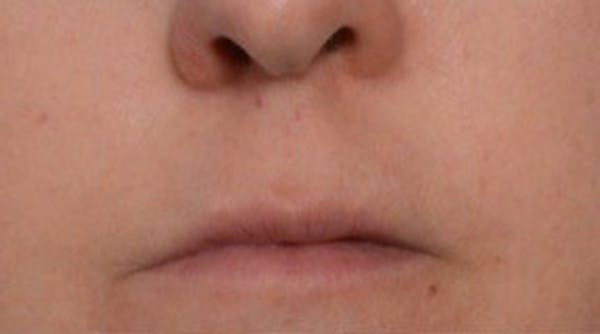 Lip Lift Before & After Gallery - Patient 146779457 - Image 1
