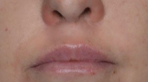 Lip Lift Before & After Gallery - Patient 146779457 - Image 2