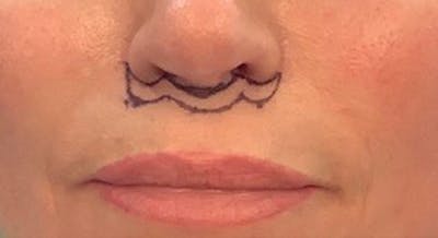 Lip Lift Before & After Gallery - Patient 146779456 - Image 1