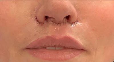 Lip Lift Before & After Gallery - Patient 146779456 - Image 2