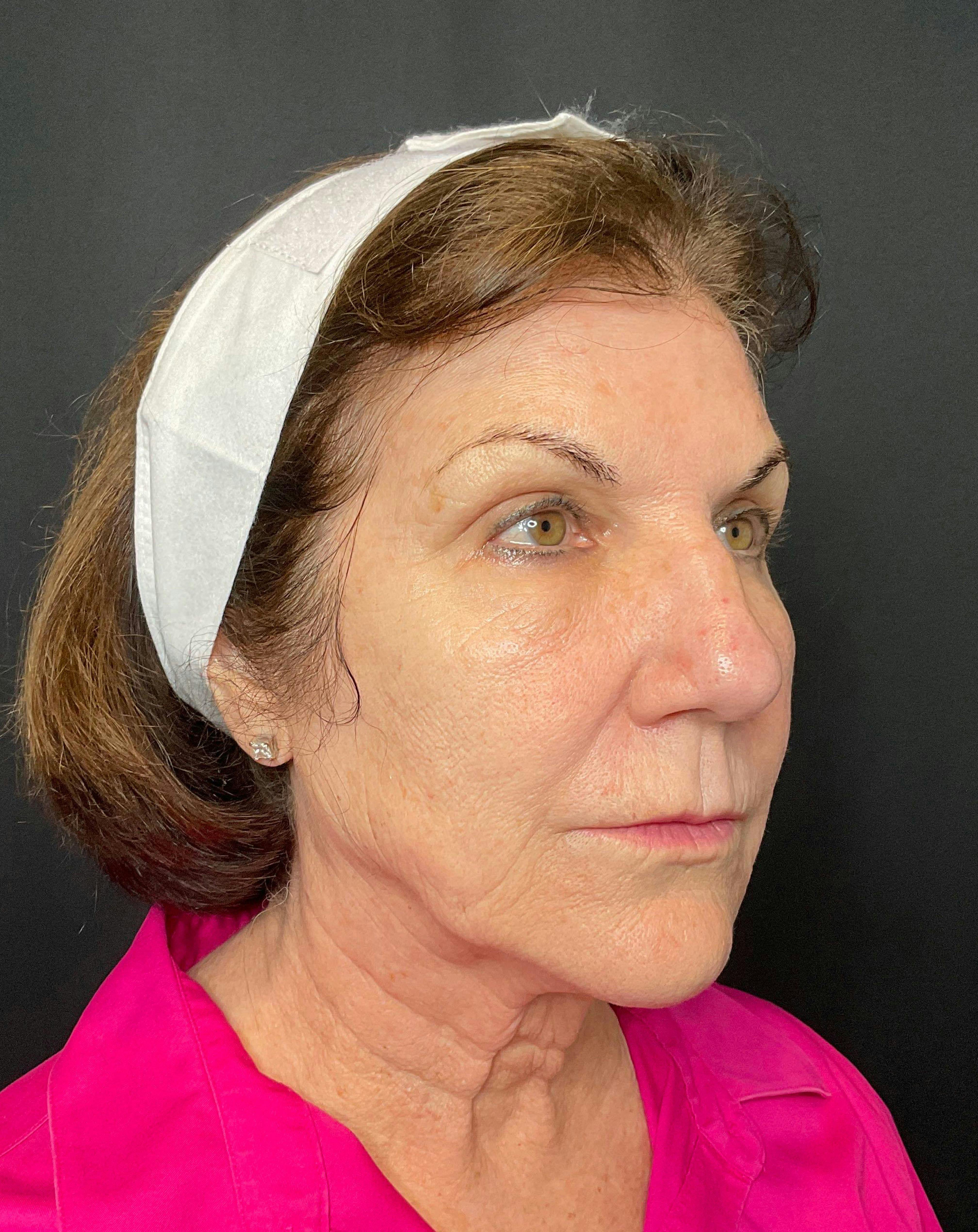 CO2 Laser Resurfacing Before & After Gallery - Patient 168659975 - Image 1