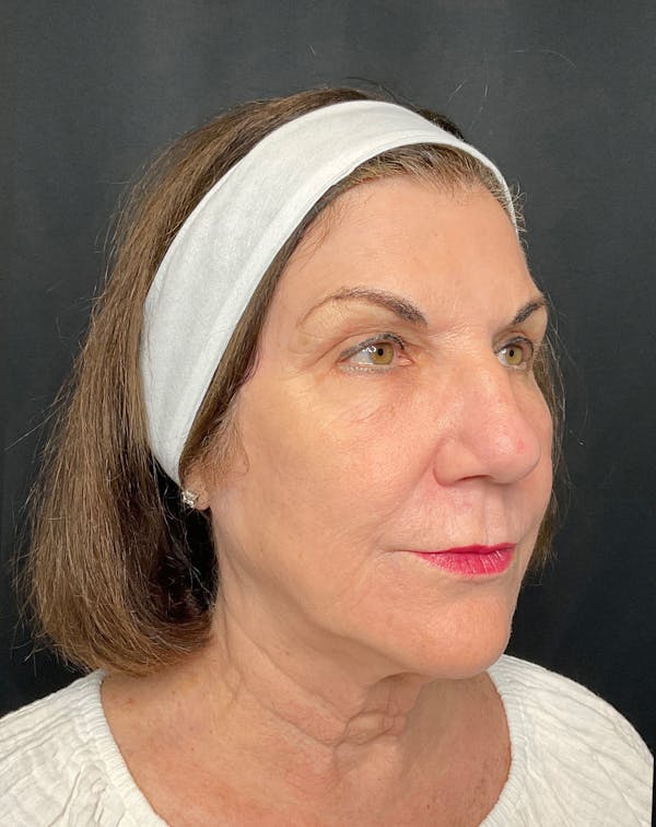 CO2 Laser Resurfacing Before & After Gallery - Patient 168659975 - Image 2