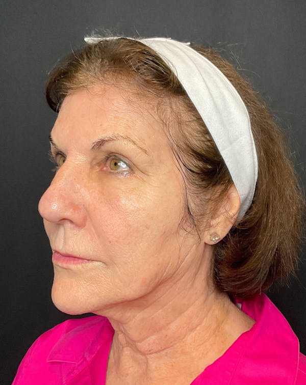 CO2 Laser Resurfacing Before & After Gallery - Patient 168659975 - Image 3