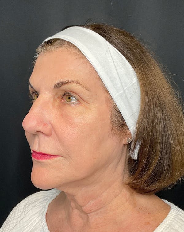 CO2 Laser Resurfacing Before & After Gallery - Patient 168659975 - Image 4