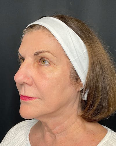 CO2 Laser Resurfacing Before & After Gallery - Patient 168659975 - Image 4