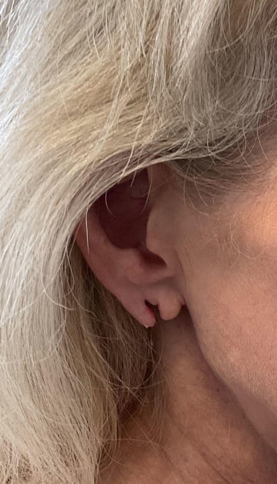 Earlobe Repair Before & After Gallery - Patient 169736520 - Image 1