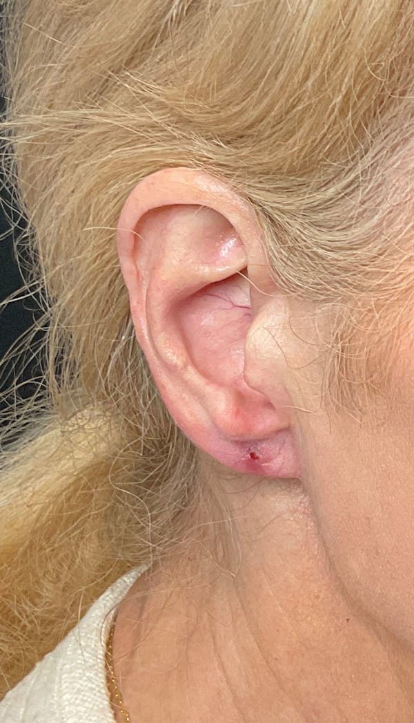 Earlobe Repair Before & After Gallery - Patient 169736520 - Image 2