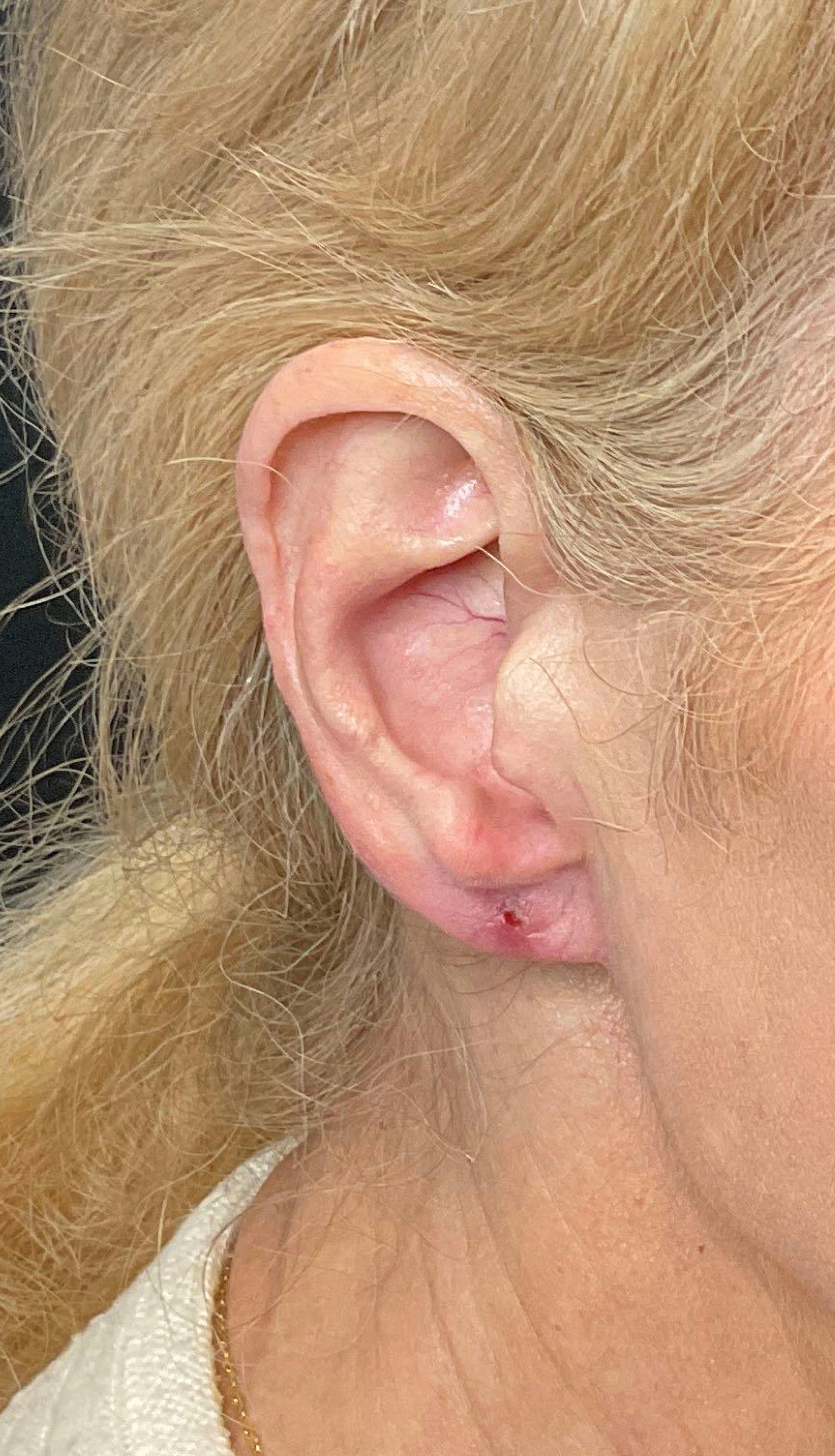 Earlobe Repair Before & After Gallery - Patient 169736520 - Image 2