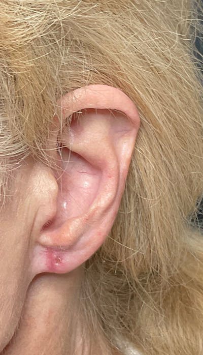 Earlobe Repair Before & After Gallery - Patient 169736520 - Image 4