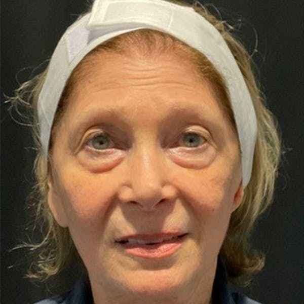 Eyelid Surgery Before & After Gallery - Patient 173728268 - Image 1