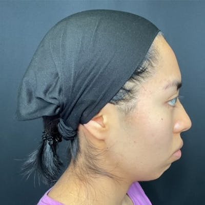 Chin Surgery Before & After Gallery - Patient 179610718 - Image 1