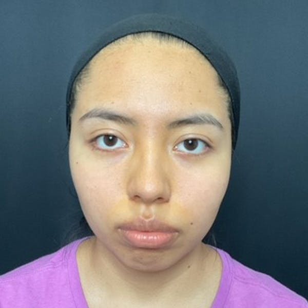 Chin Surgery Before & After Gallery - Patient 179610718 - Image 3
