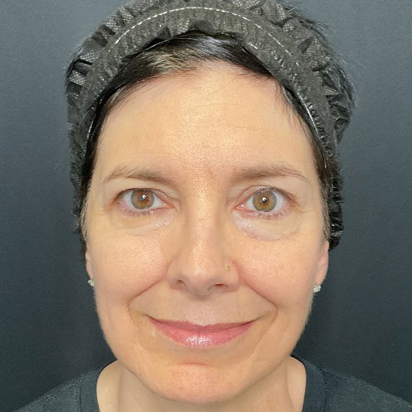 Brow Lift Before & After Gallery - Patient 179611247 - Image 1
