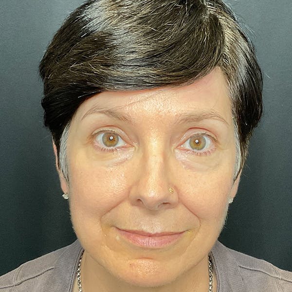 Brow Lift Before & After Gallery - Patient 179611247 - Image 2
